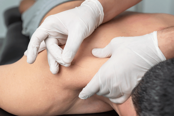 Tight Shoulders? Try Dry Needling Therapy